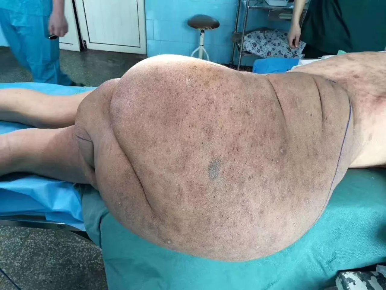 30多斤重的"神经纤维瘤"……这是1月19日发生在长治县人民医院的一幕