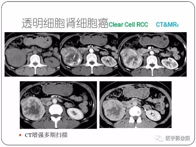 肾细胞癌分型和分期的影像详解丨影像天地