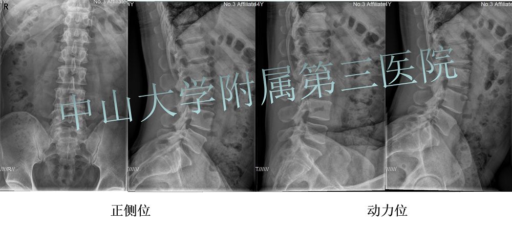 a 椎管(侧隐窝)狭窄 b 腰椎间盘突出 c 椎间孔狭窄  d 椎间盘内破裂