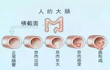 越来越常见结肠息肉危害很大,有了怎么办?