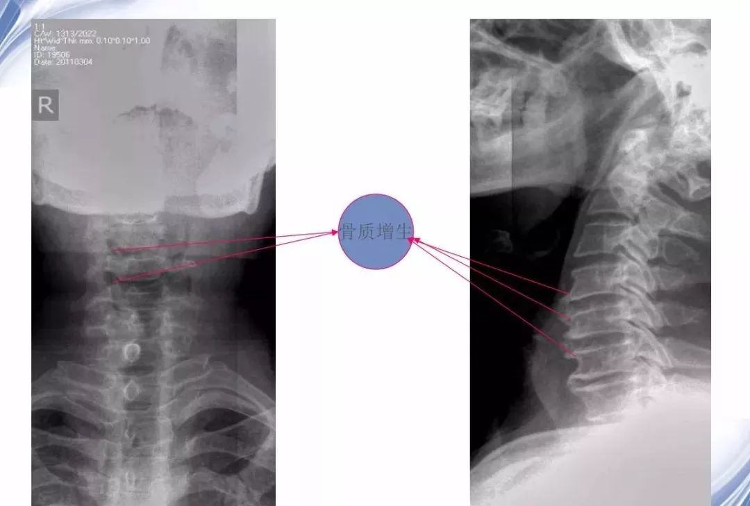 颈椎x线诊断技巧及其解读1建议收藏