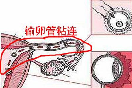 双侧输卵管粘连多囊卵巢综合征白衣天使也患不孕症