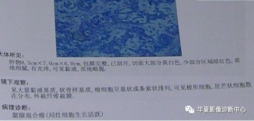 腮腺混合瘤ct病例图片影像诊断分析