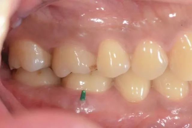 2017年7月,牙周基础治疗3个月后,左下磨牙牙龈瘘管又出现.