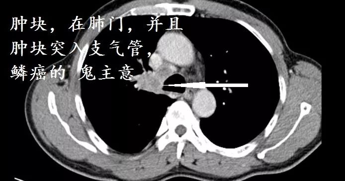 肺ct也会装酷:如何从ct上看出肺癌的病理类型?