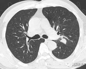 【病例】左肺上叶胸膜下见结节灶,局部边边缘毛糙