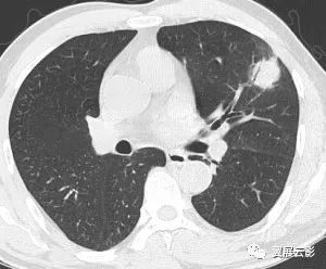 【病例】左肺上叶胸膜下见结节灶,局部边边缘