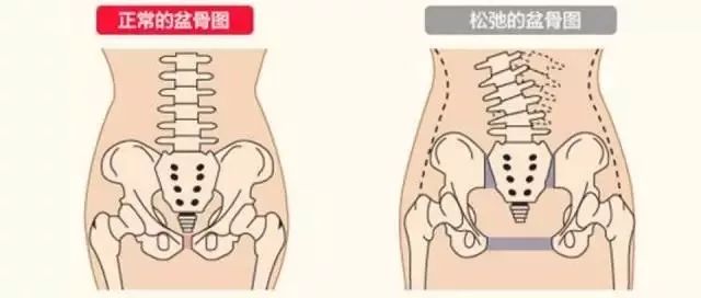 产后胯骨变宽怎么办? | 问答