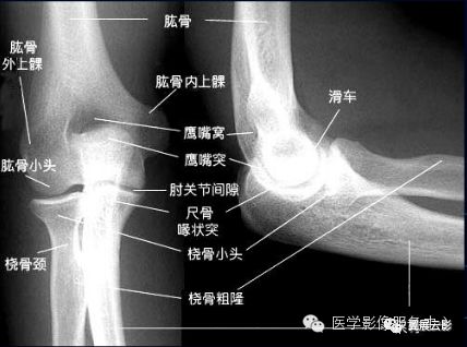 侧位桡骨小头与尺骨冠突重叠,正位桡骨小头似戴帽非戴帽.