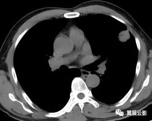 【病例】左肺上叶胸膜下见结节灶,局部边边缘