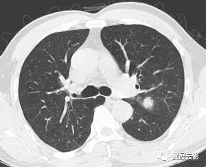 【病例】左肺上叶胸膜下见结节灶,局部边边缘毛糙