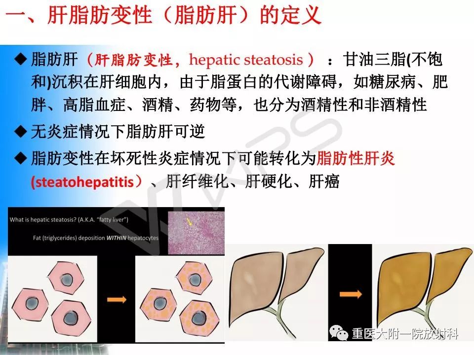 肝脏脂肪变性影像学 特征及鉴别诊断