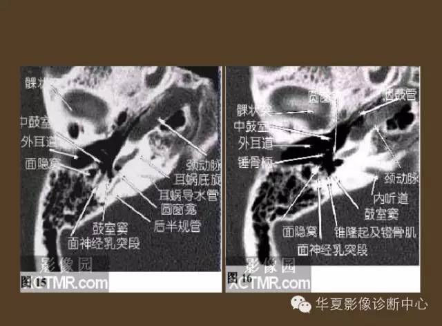 好详细的解剖 — 耳部hrct图像详解