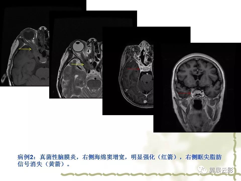 海绵窦解剖和12种常见疾病影像诊断