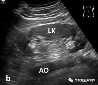 a图显示腋后线矢状切面(黄色箭头),b图腋后线矢状切面超声显示肾脏与