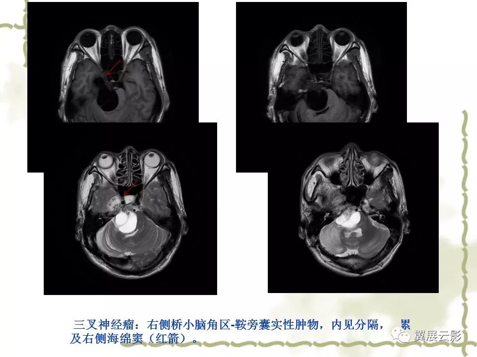 海绵窦解剖和12种常见疾病影像诊断