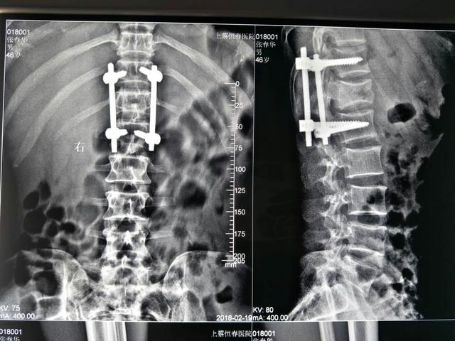 上蔡恒春医院骨科李京超主任:手术成功治疗胸腰椎压缩粉碎性骨折