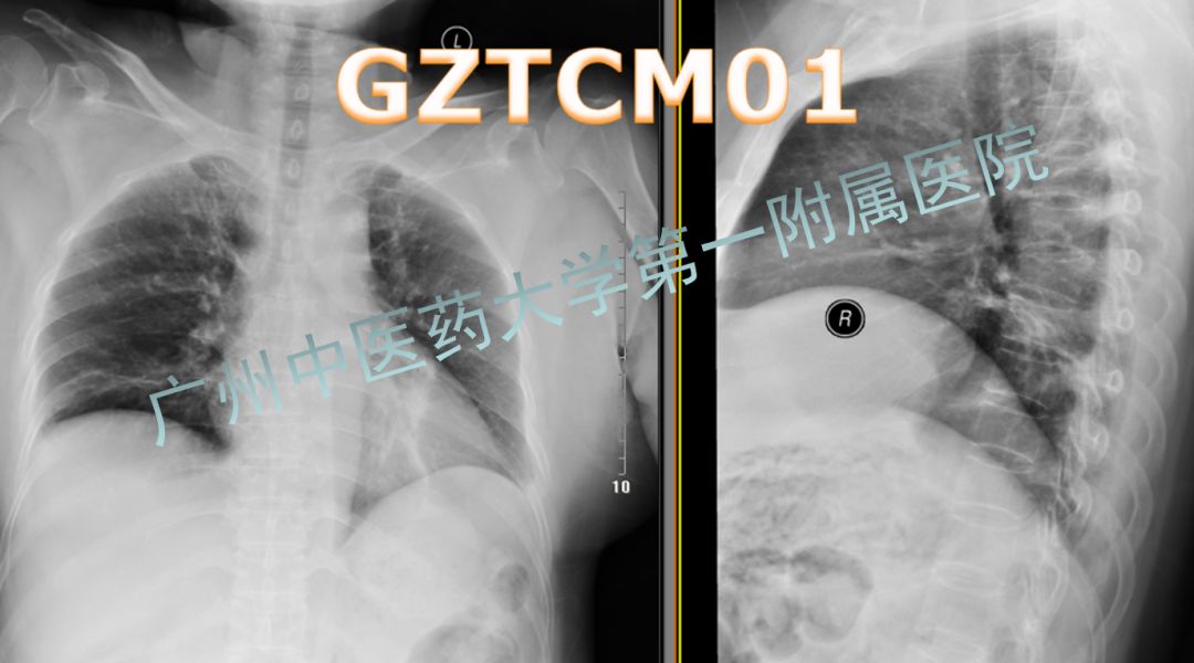 对保守治疗无效的单纯腰椎间盘突出症患者来说,经皮椎间孔镜椎间盘