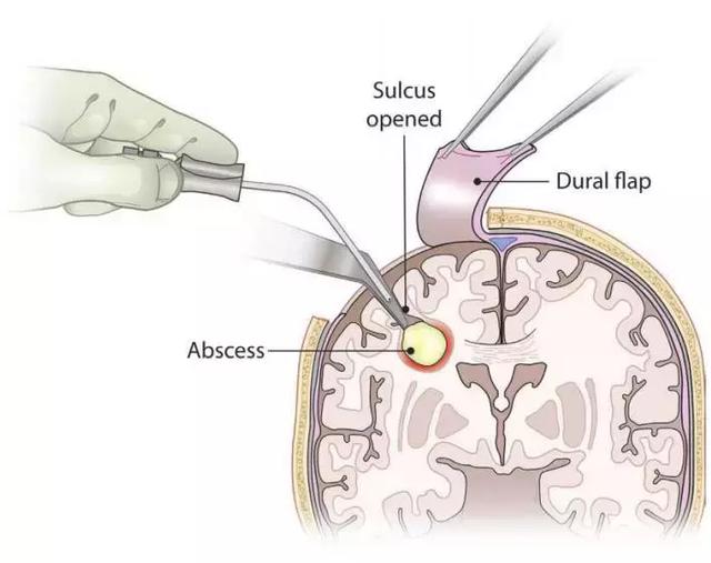 急性颅内感染的手术治疗