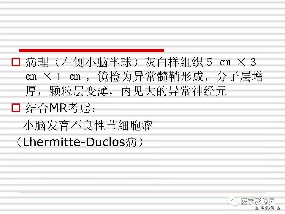 病理结果:小脑发育不良性节细胞瘤china-radiology审稿:春晓编辑:非羽