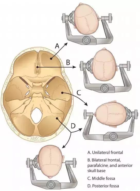 parafalcine,and anterior skull base双侧额部,大脑镰旁,前颅底 c