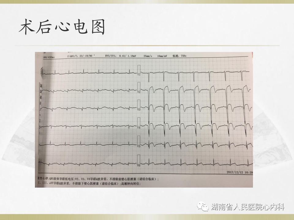 湖南省人民医院胸痛中心急性心梗病例【12月份第二部分】