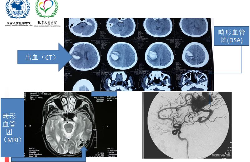 [课件]小儿脑血管畸形的科普知识与临床案例-蔡英杰