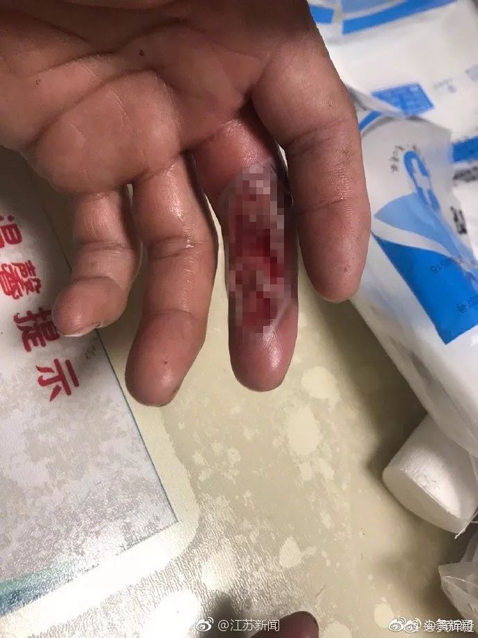 从图片上可以看到,清洁工人的手受伤真的很严重.