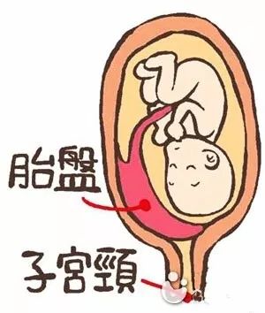 孕妇遇"胎盘前置状态"惊险万分