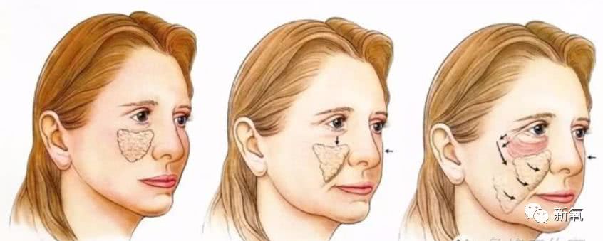 型则更年轻一点,通常是面部还没有明显下垂,可是已经出现了印第安纹