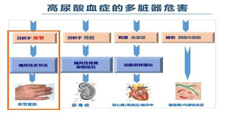 从这个意义上来讲,痛风性关节炎,是高尿酸患者体内的尿酸盐分流到关节