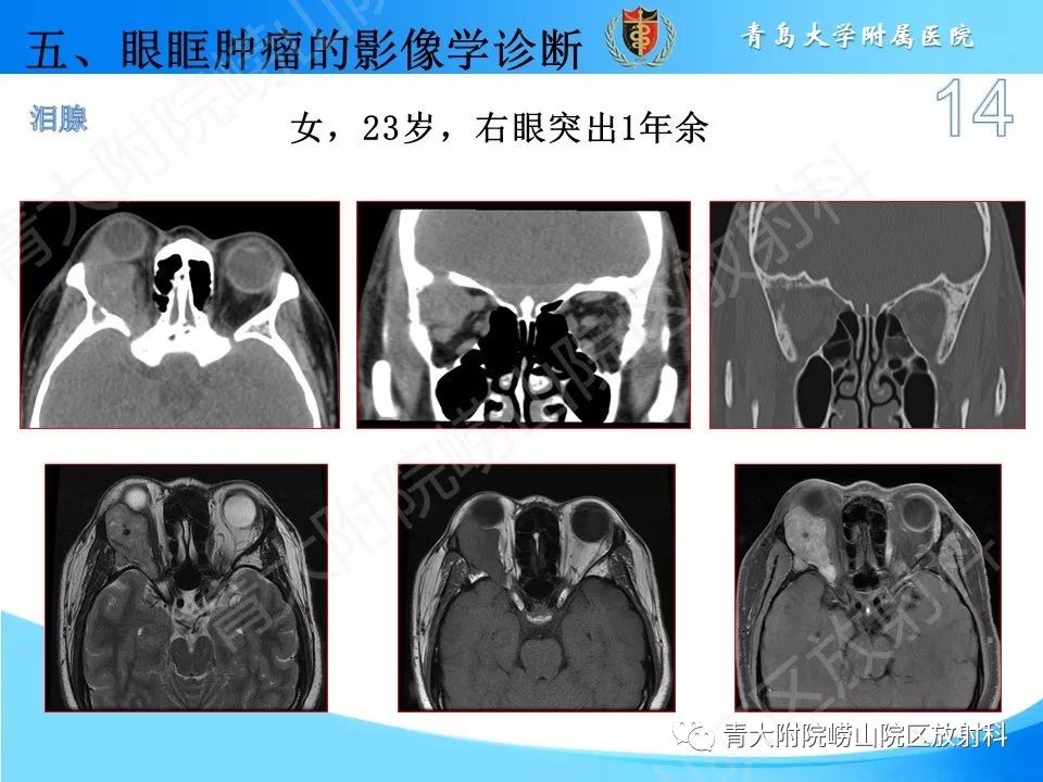 眼眶肿瘤的影像诊断