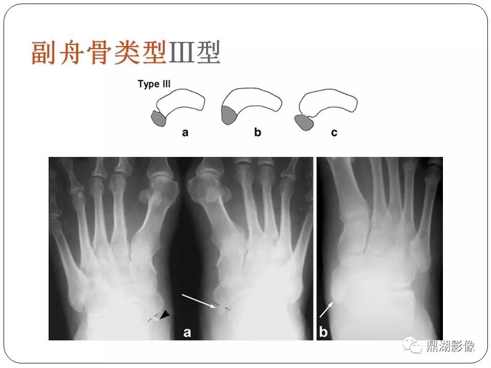 足舟骨结节骨折和副舟骨的鉴别