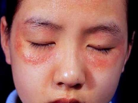 红疹是皮肤过敏的典型症状,眼周出现红疹一定要高度重视,因为红疹是