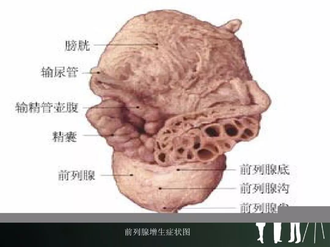 经尿道前列腺电切术后的护理