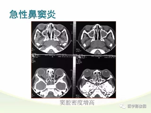 十余种鼻和鼻窦病变ct诊断要点丨影像天地