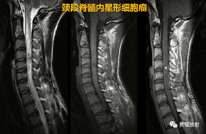 罕见丨髓内神经鞘瘤丨mri表现及鉴别诊断