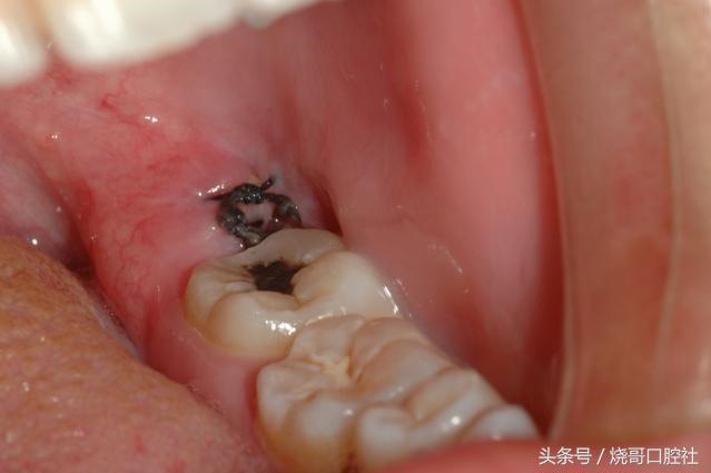2,拔牙后注意不能破坏血凝块或者舌头舔创口,24小时后含有氯