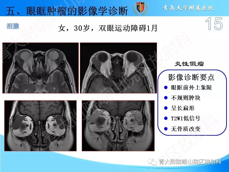 眼眶肿瘤的影像诊断