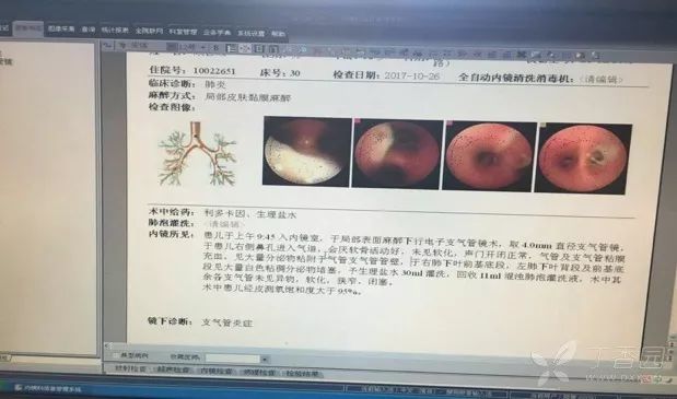 治疗支原体肺炎患儿纤维支气管镜怎么用何时用