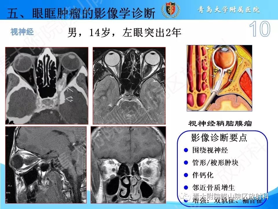 眼眶肿瘤的影像诊断