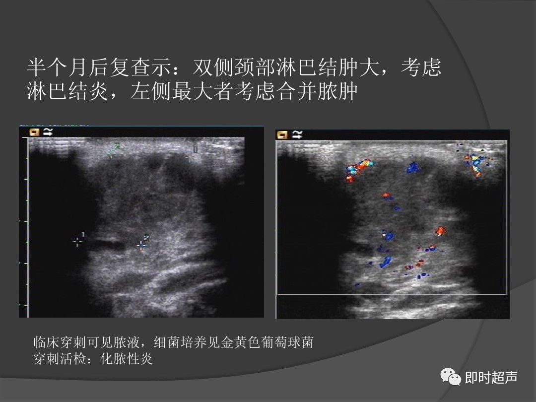 常见淋巴结疾病及其超声表现