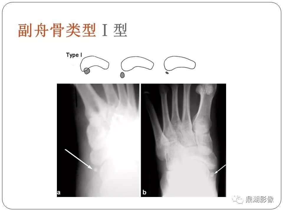 足舟骨结节骨折和副舟骨的鉴别