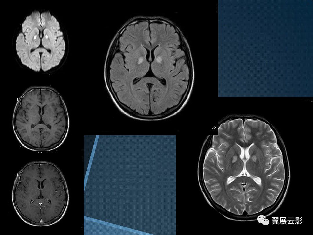 基底节区丘脑区对称性病变总结