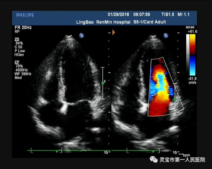 心脏彩超图像