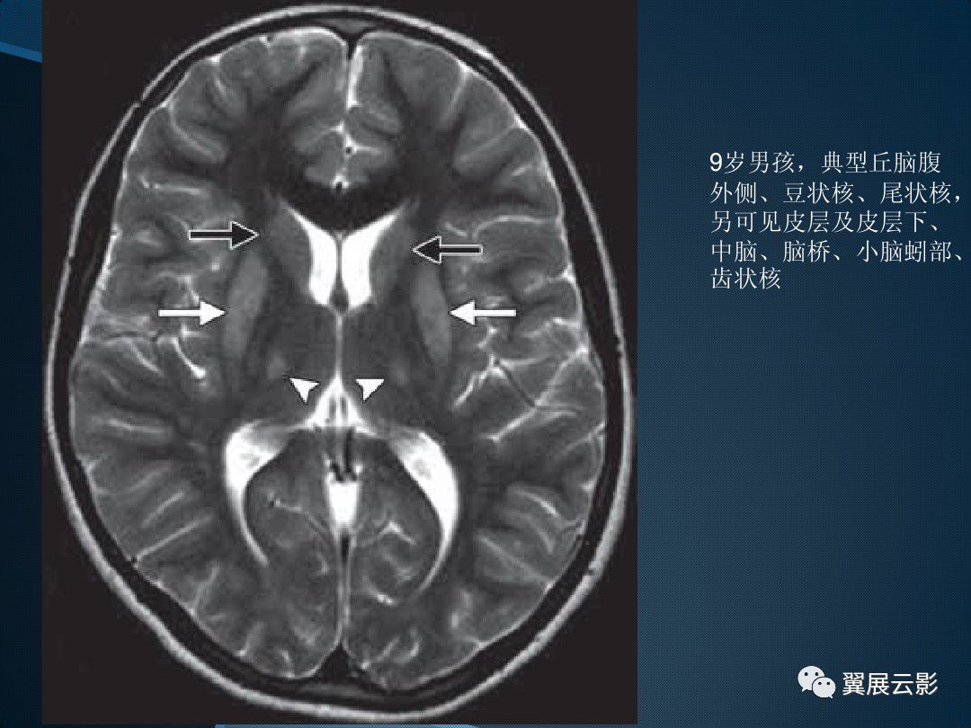 基底节区-丘脑区对称性病变总结