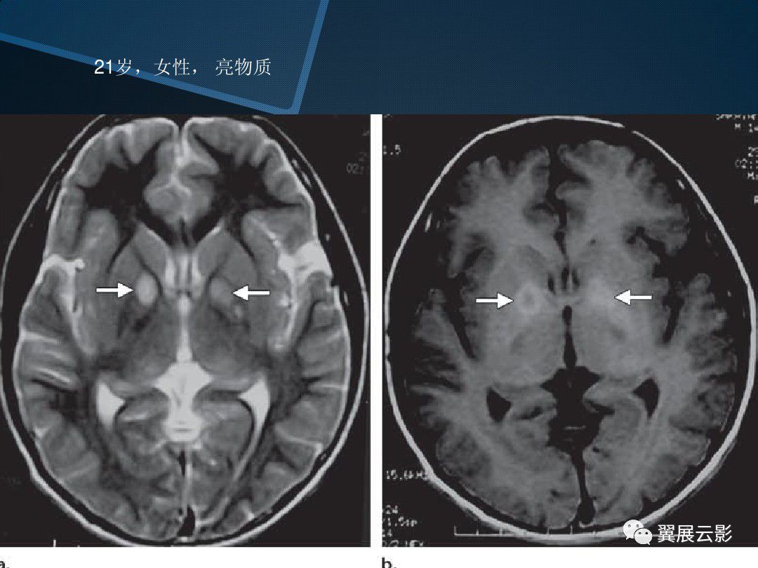 基底节区丘脑区对称性病变总结