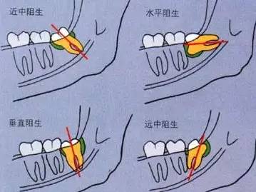 2 造成邻牙病变  阻生智齿中典型的"秀恩爱,死得快"型,智齿因为萌出