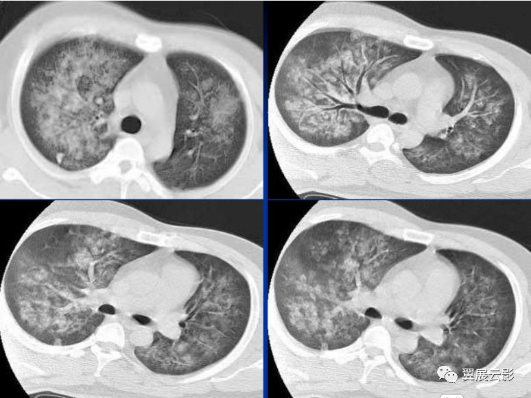 不同类型肺水肿的ct表现,你都知道吗?