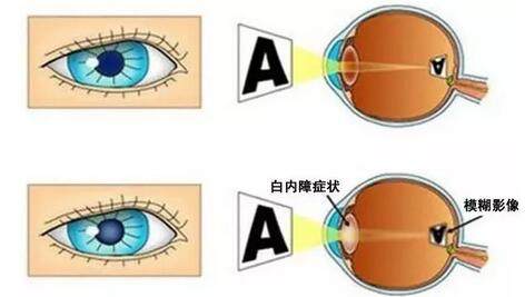 白内障眼部症状示意图